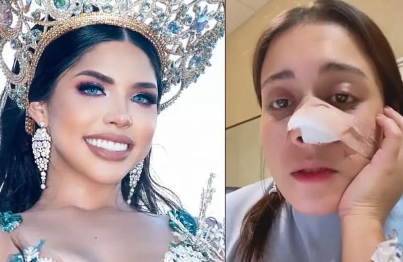 ¡Que altruista! Yeri MUA regalará cirugía estética a joven que le arrancaron la nariz de una mordida