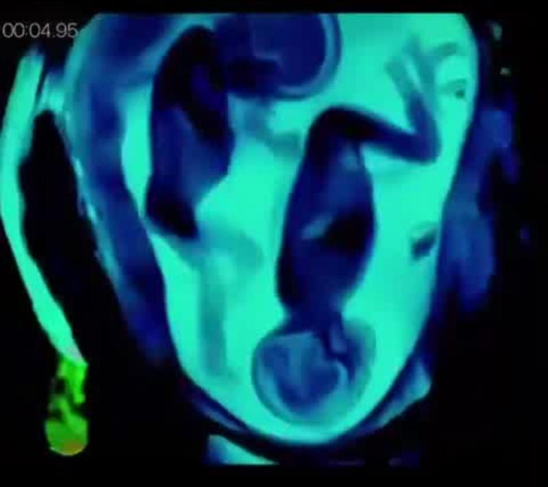 ¡Ternurita! Gemelas gestantes son captadas peleando en el vientre de su mamá (+VIDEO)