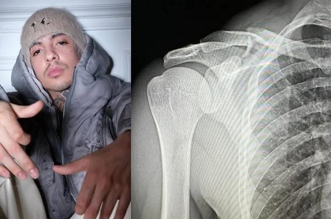 Natanael Cano sufre aparatoso accidente ¡Tiene fractura de clavícula!