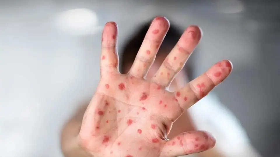 ¡Busca tu cartilla de vacunación! Lo que debes saber sobre el sarampión 