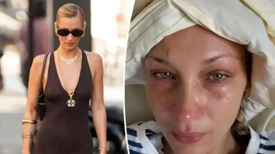 Bella Hadid revela nueva recaída por la enfermedad de Lyme